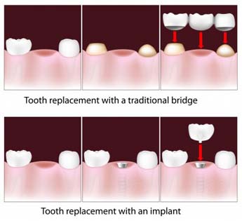 dental bridge example
