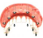 All on 6 dental implants Thailand